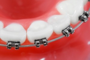 How to care for your teeth when wearing braces