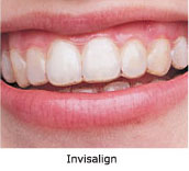 Invisalign