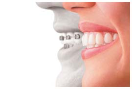 invisalign