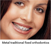 Traditional Braces