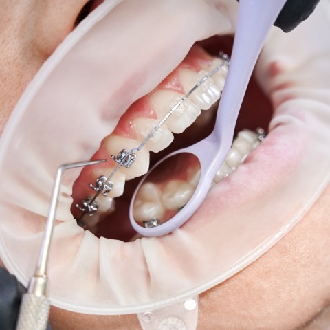 Close-up of ceramic braces fitted on teeth during orthodontic treatment, showing discreet tooth-coloured brackets
